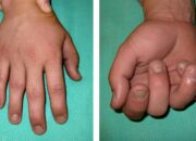 Dream Meaning of Broken Someones Fingers