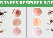 Dream Meaning of Spider Bite