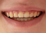 Dream Meaning of Yellow Teeth