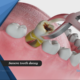 Dream Meaning of Pulling Your Own Rotten Teeth Out