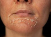 Dream Meaning of Peeling Skin