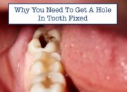 Dream Meaning of Holes In Teeth