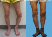Dream Meaning of Deformed Legs