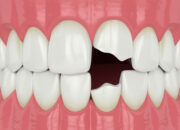 Dream Meaning of Broken Tooth