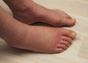 Dream Meaning of Swollen Feet