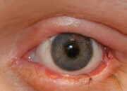 Dream Meaning of Eyelashes Falling Out