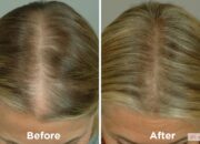 Dream Meaning of Losing My Hair