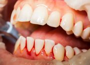 Dream Meaning of Bleeding Gums
