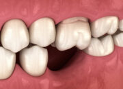 Dream Meaning of Losing Bottom Teeth