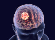 Dream Meaning of Brain Tumor