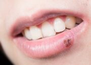 Dream Meaning of Cold Sores