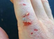Dream Meaning of Finger Bitten By Dog