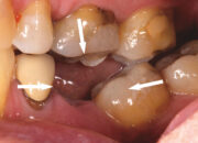 Dream Meaning of Losing Teeth One By One
