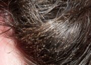 Dream Meaning of Lice In Someone& 39