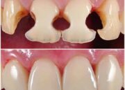 Dream Meaning of A Tooth Filling