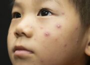 Dream Meaning of Having Chicken Pox