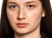 Dream Meaning of Scars On Face