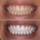 Dream Meaning of Whitening Teeth