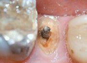 Dream Meaning of Losing Crown Tooth