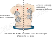 Dream Meaning of Open Chest Wound