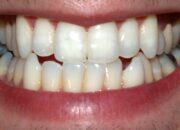 Dream Meaning of Teeth