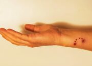 Dream Meaning of Dog Bite On Hand