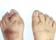 Dream Meaning of Ugly Feet