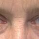 Dream Meaning of Losing An Eye