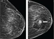 Dream Meaning of Bleeding Breast