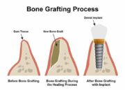 Dream Meaning of Picking Bones Out Of My Teeth