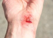 Dream Meaning of Wounded Hand