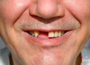 Dream Meaning of Losing Front Tooth