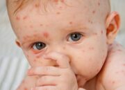 Dream Meaning of Chicken Pox
