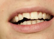 Dream Meaning of Chipped Tooth