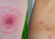 Dream Meaning of Getting Bit By Insects