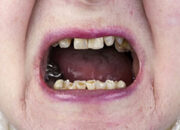 Dream Meaning of Your Teeth Crumbling