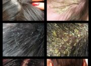 Dream Meaning of Scalp Dandruff
