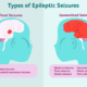 Dream Meaning of Having Seizures