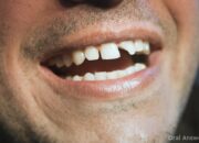 Dream Meaning of Tooth Filling Falling Out