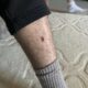 Dream Meaning of Hole In Leg