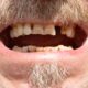 Dream Meaning of Teeth Breaking And Falling Out