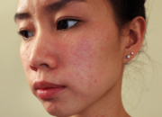Dream Meaning of Allergic Reaction Face