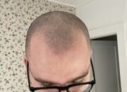 Dream Meaning of Going Bald