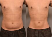Dream Meaning of Liposuction