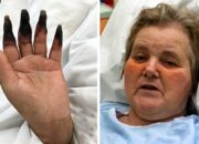 Dream Meaning of Loss Of Fingers And Toes