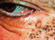 Dream Meaning of Popping Pimples