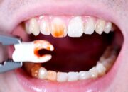Dream Meaning of Teeth Being Pulled Out