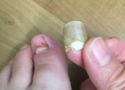 Dream Meaning of Toenail Falling Off