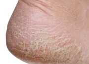 Dream Meaning of Feet Peeling