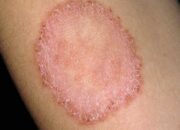 Dream Meaning of Ringworm